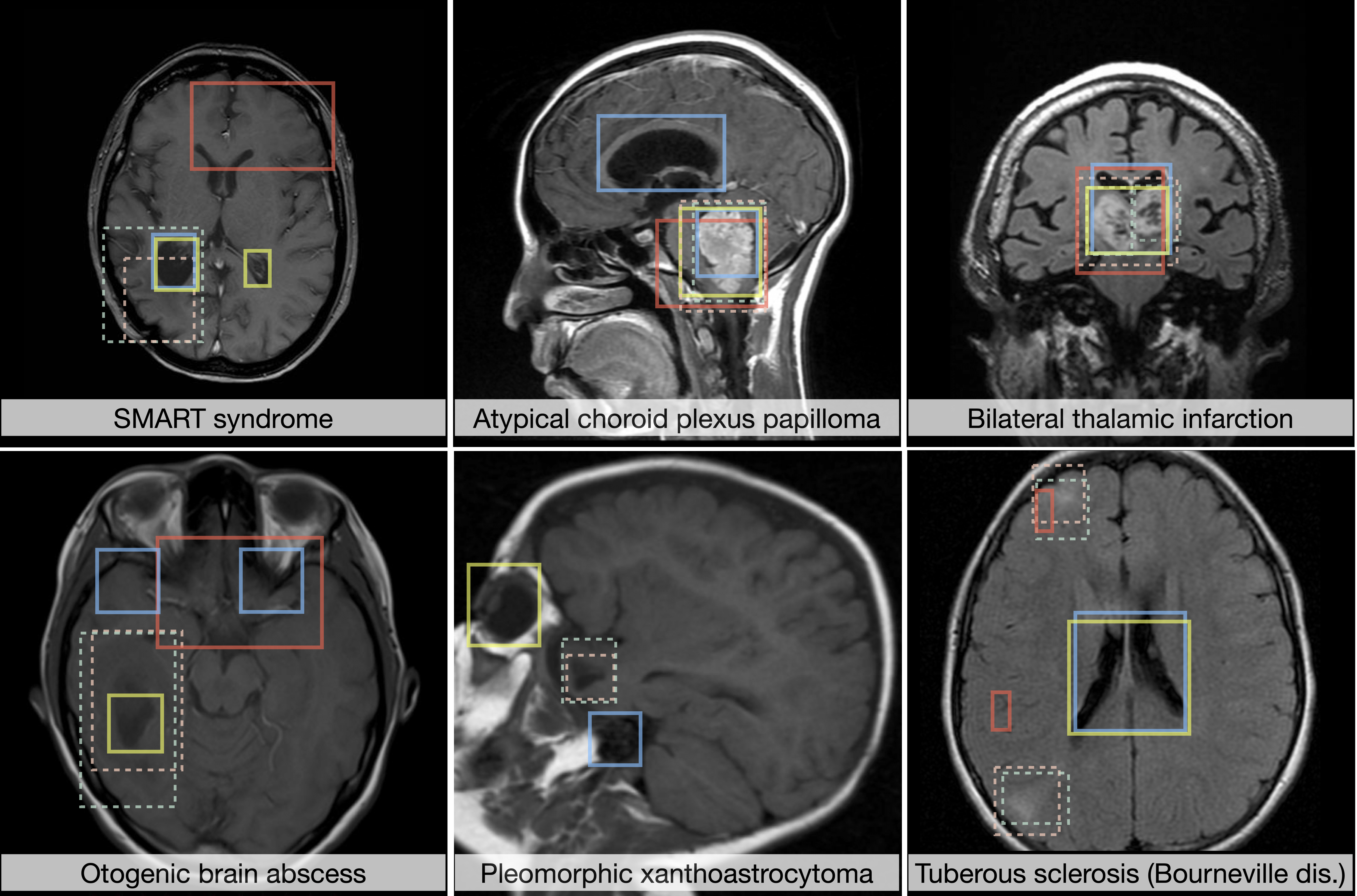 NOVA: A Benchmark for Rare Anomaly Localization and Clinical Reasoning in Brain MRI